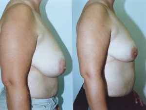 Breast Reduction with Liposuction