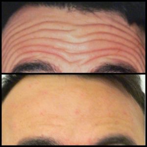 Muscle Relaxant Injections - Forehead